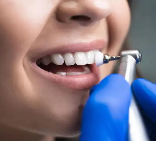Diş Beyazlatma Nedir?