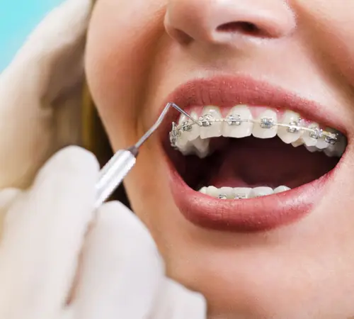 Ortodonti Nedir? Diş Teli Tedavisi ve Aşamaları