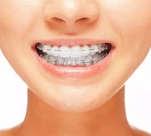 Ortodontik Tedavi Sırasında Ağız Bakımı Nasıl Yapılmalı?
