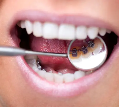 Ortodontik Tedavi Ne Kadar Sürer? Süreç ve Etkili Sonuçlar